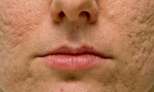 traitement-acne-valdoise