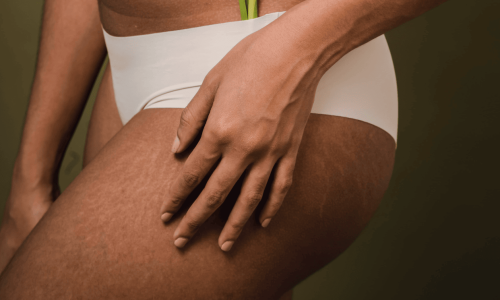 image du corps d'une femme avec des vergetures sur les cuisses